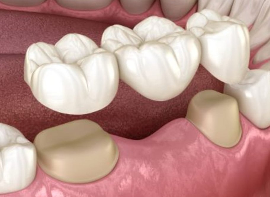 Dental implants